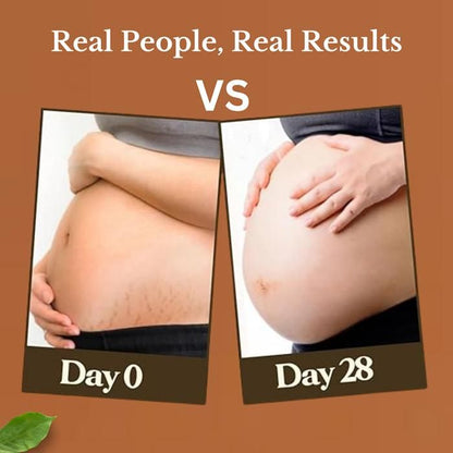 Organic Stretch Mark Cream Oil Mark Removal - Natural Heal Pregnancy Breast, Legs, after pregnancy delivery